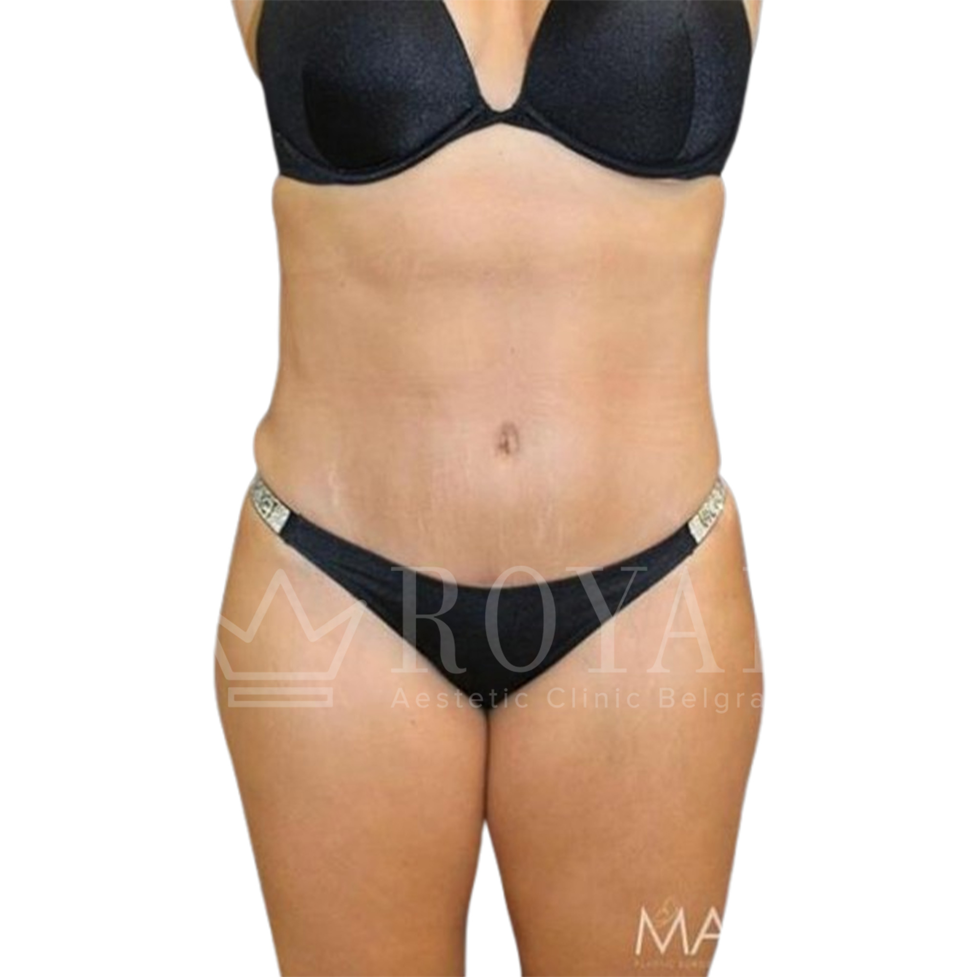Plastic surgery Royal | Before and after