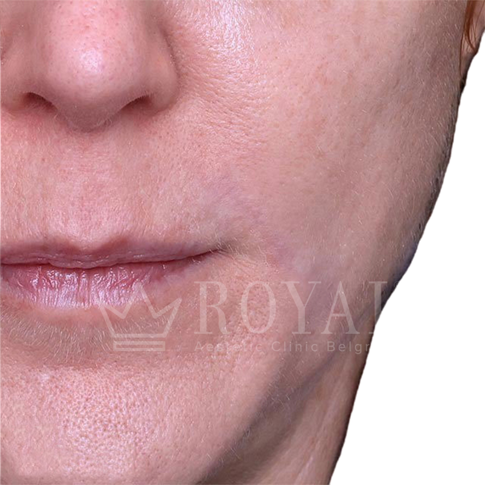 Plastic surgery Royal | Before and after