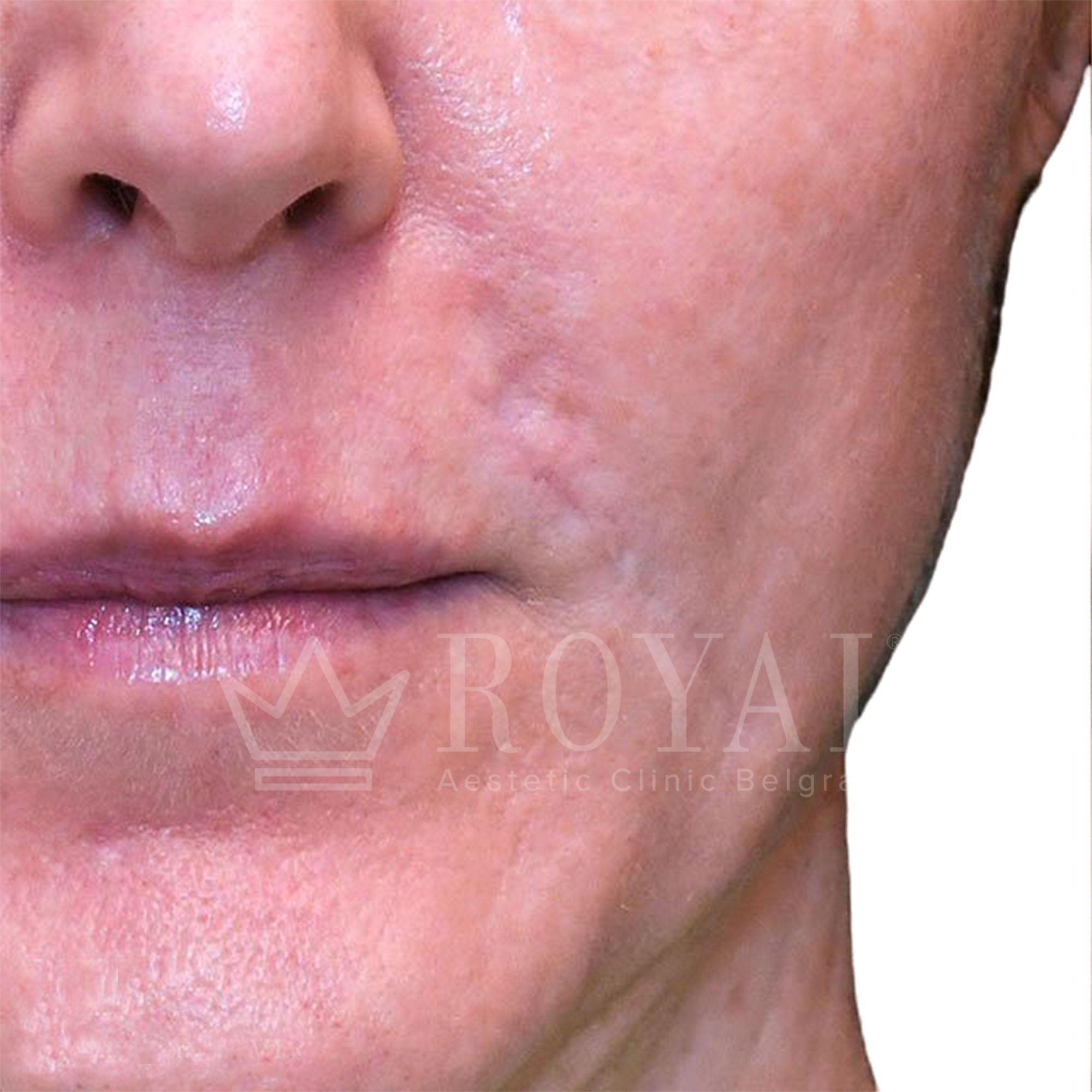 Plastic surgery Royal | Before and after