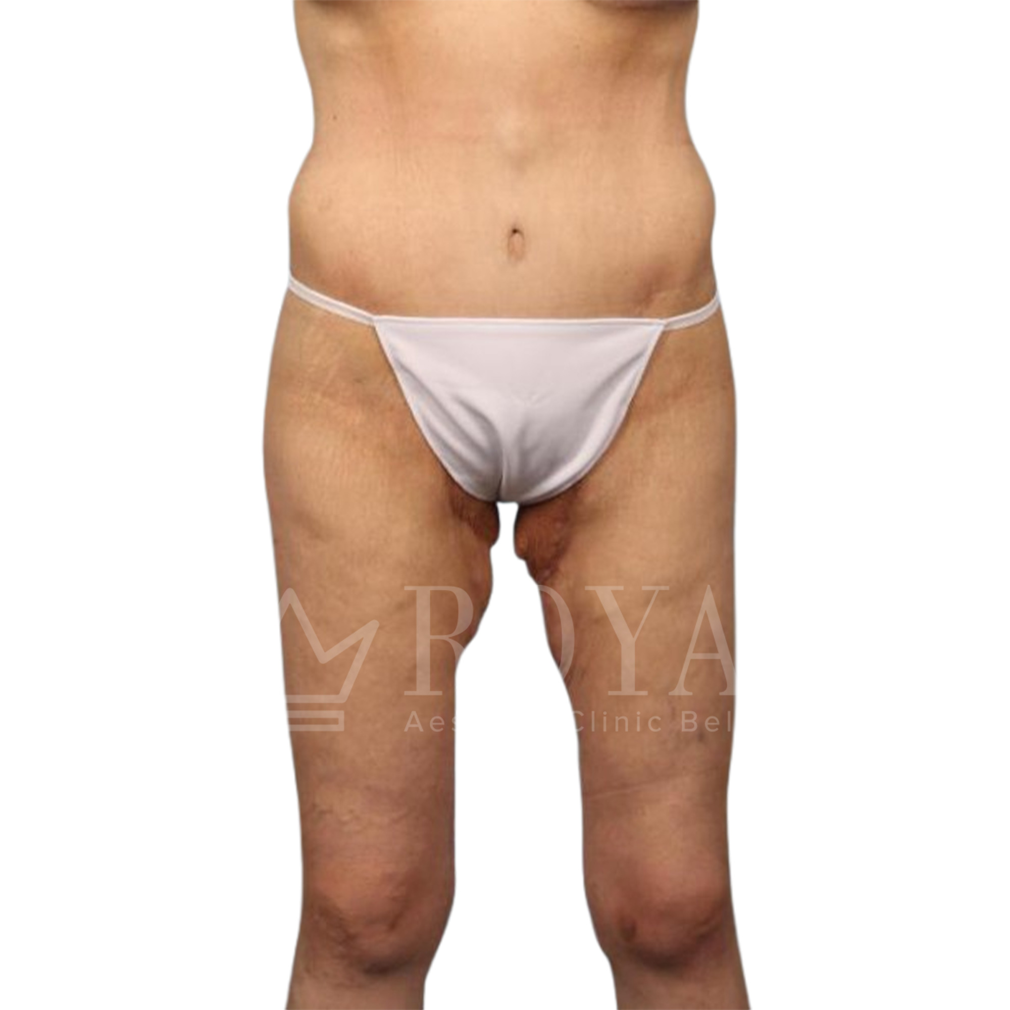 Plastic surgery Royal | Before and after