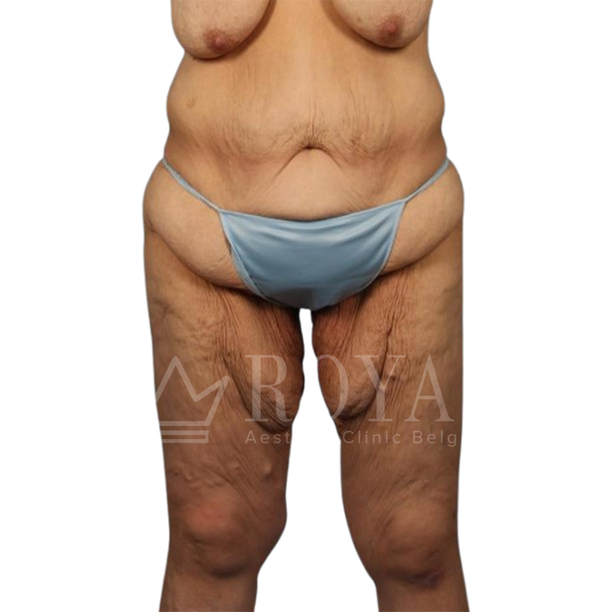 Plastic surgery Royal | Before and after