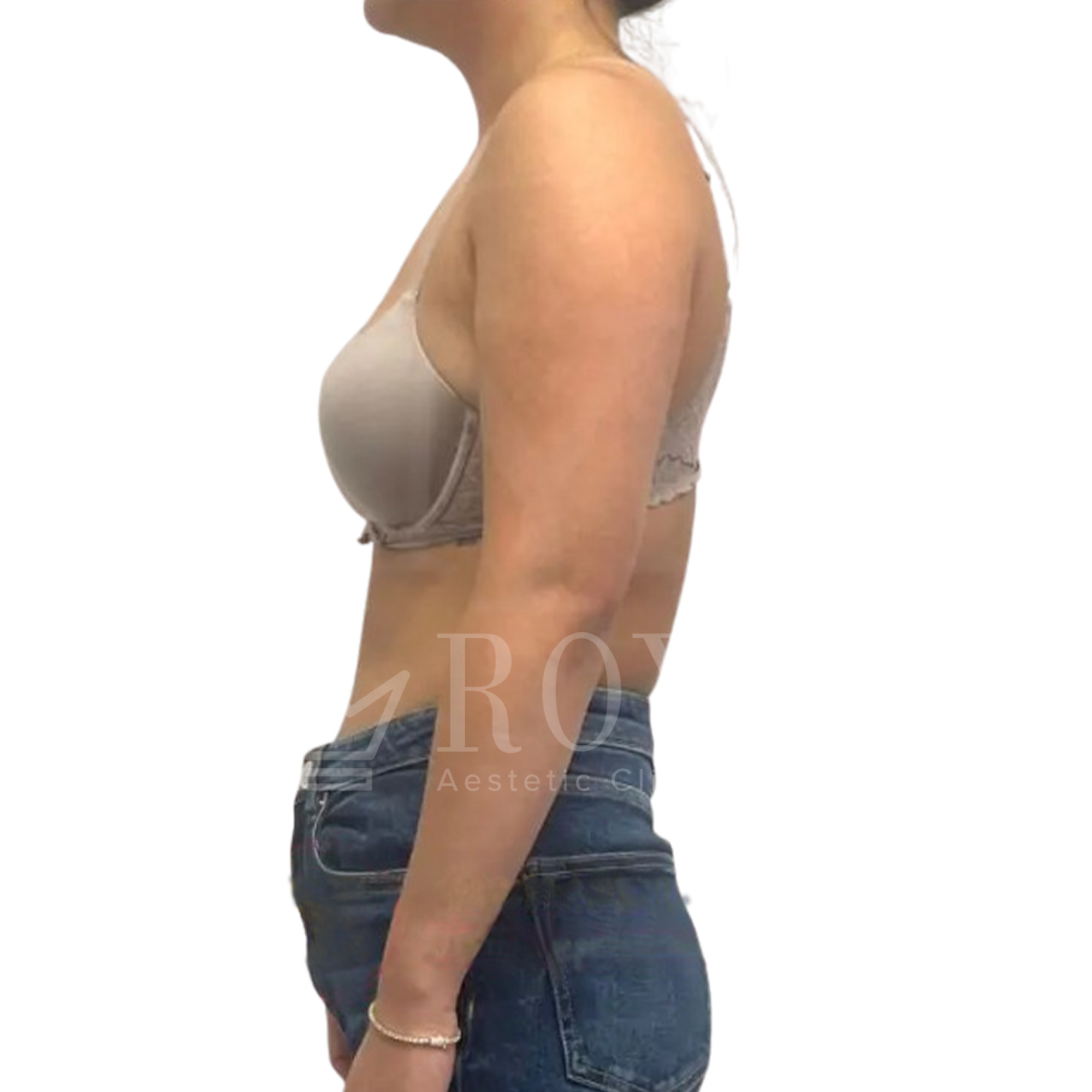 Plastic surgery Royal | Before and after