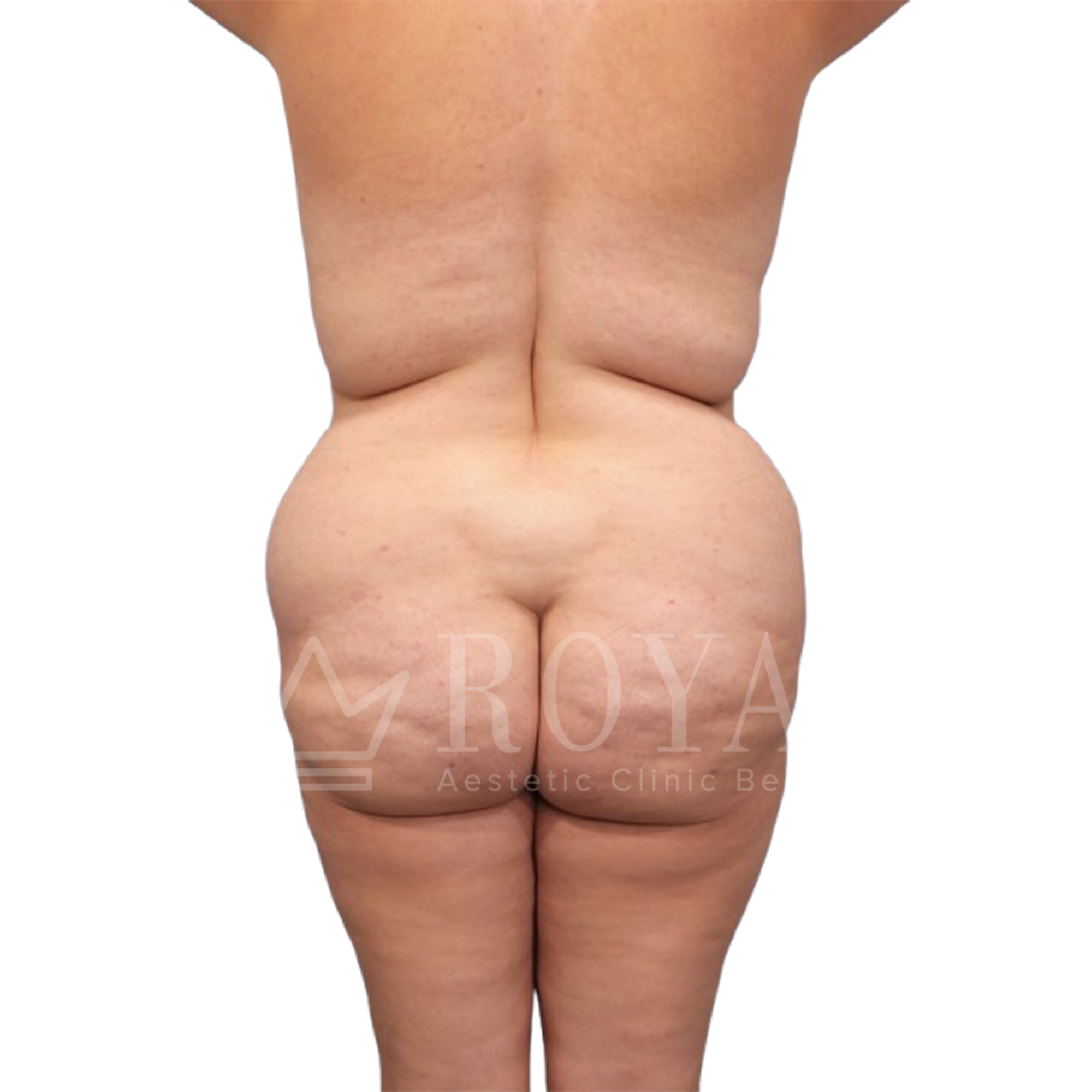 Plastic surgery Royal | Before and after