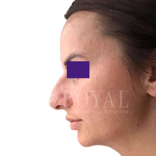 Plastic surgery Royal | Before and after