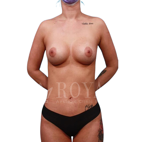 Plastic surgery Royal | Before and after