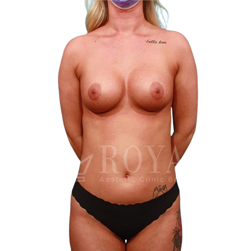 Plastic surgery Royal | Before and after