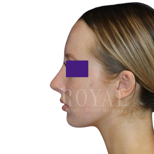 Plastic surgery Royal | Before and after