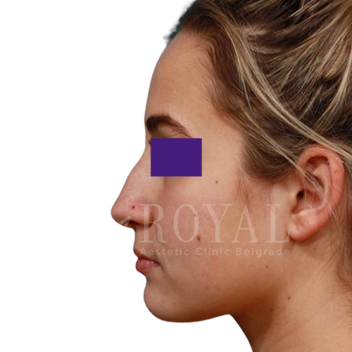 Plastic surgery Royal | Before and after