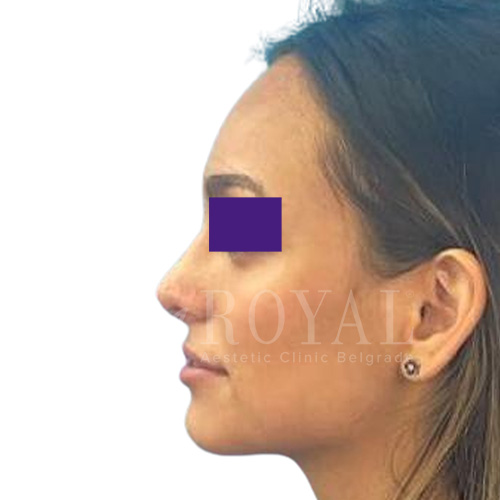 Plastic surgery Royal | Before and after