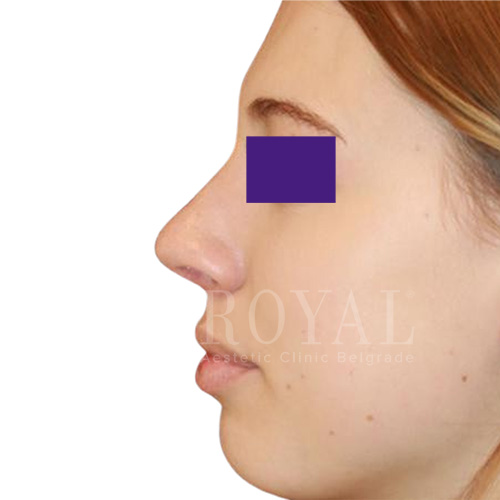Plastic surgery Royal | Before and after