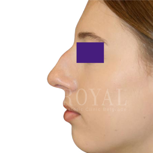 Plastic surgery Royal | Before and after