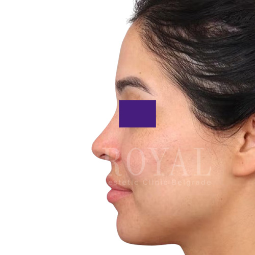 Plastic surgery Royal | Before and after
