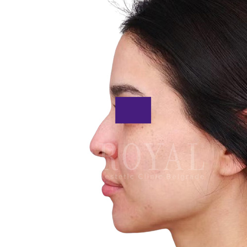 Plastic surgery Royal | Before and after