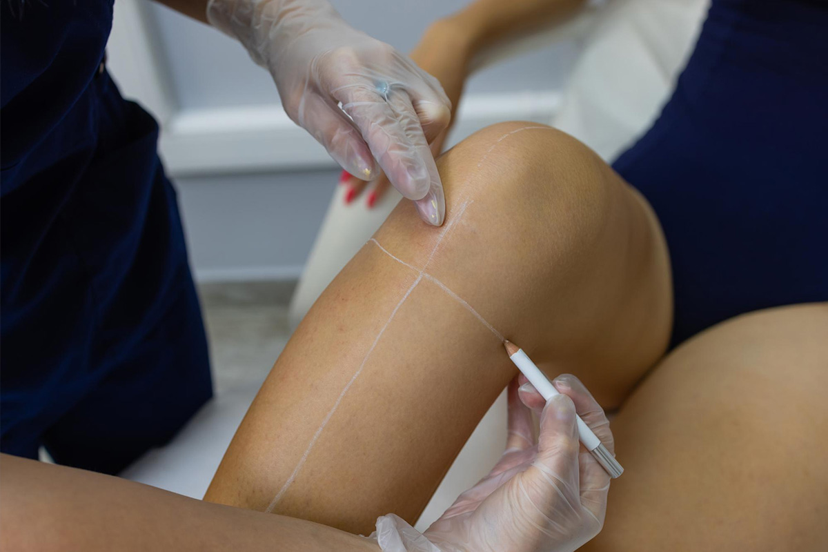 Liposukcija kolen | Liposukcija kolen