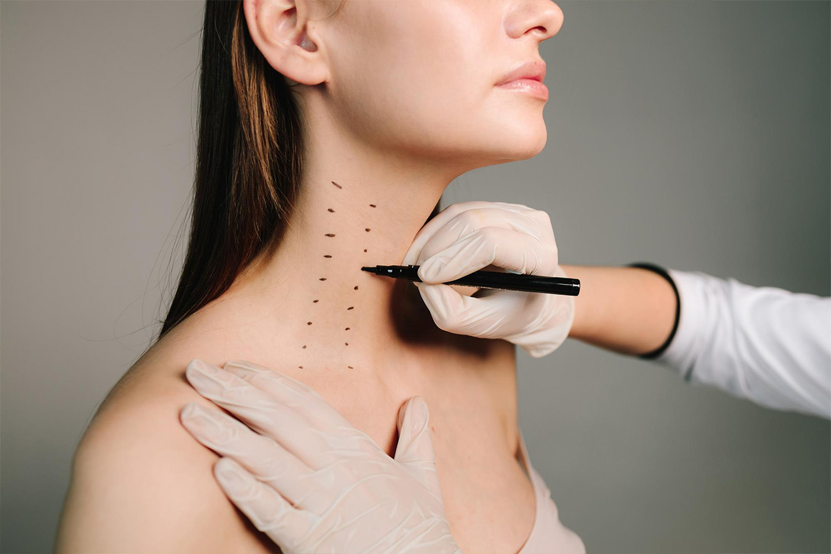 Liposukcija vratu | Liposukcija vratu