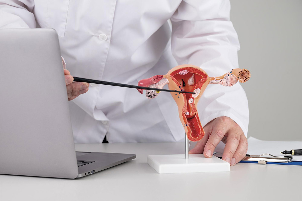 Polypectomy | Polypectomy